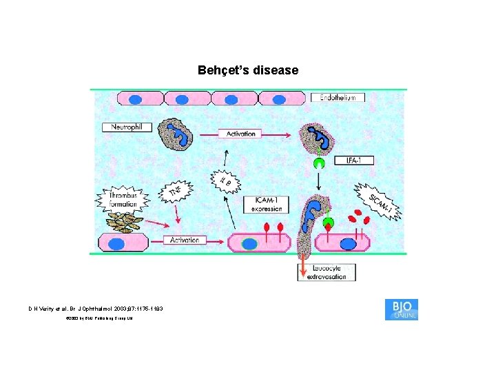 Behçet’s disease D H Verity et al. Br J Ophthalmol 2003; 87: 1175 -1183