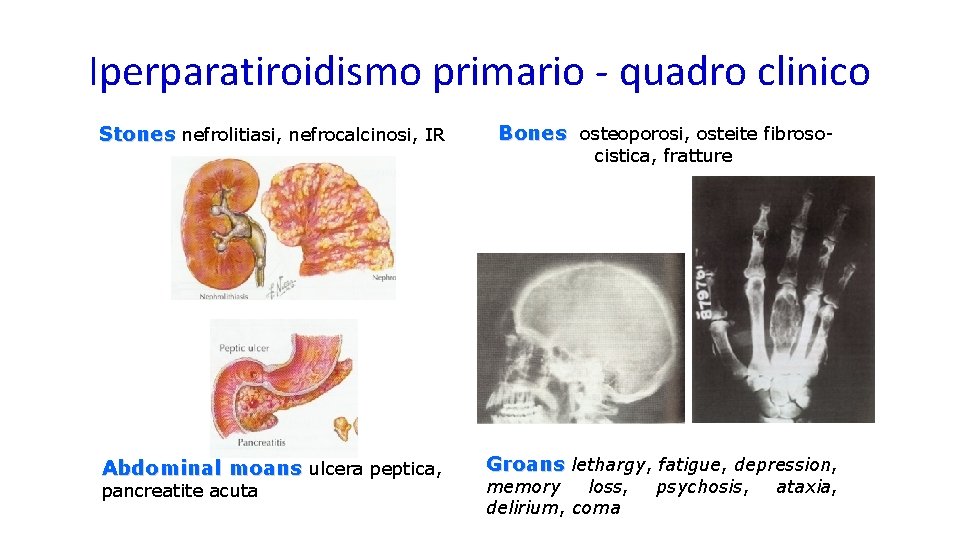 Iperparatiroidismo primario - quadro clinico Stones nefrolitiasi, nefrocalcinosi, IR Bones osteoporosi, osteite fibroso- Abdominal