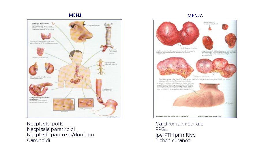 MEN 1 Neoplasie ipofisi Neoplasie paratiroidi Neoplasie pancreas/duodeno Carcinoidi MEN 2 A Carcinoma midollare