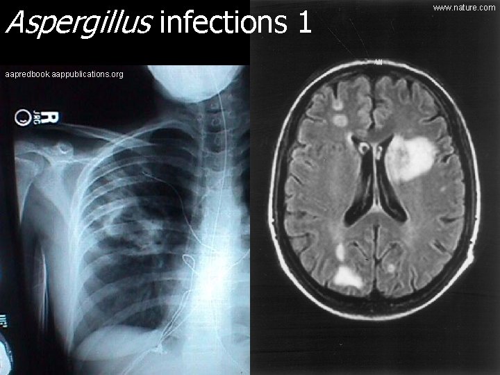Aspergillus infections 1 aapredbook. aappublications. org www. nature. com 