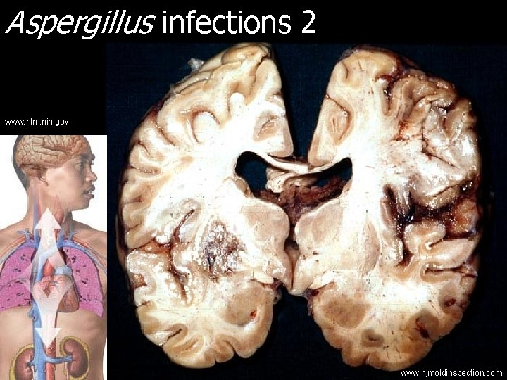 Aspergillus infections 2 www. nlm. nih. gov www. njmoldinspection. com 