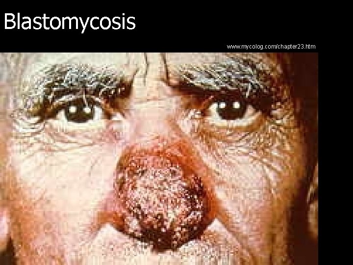Blastomycosis www. mycolog. com/chapter 23. htm 