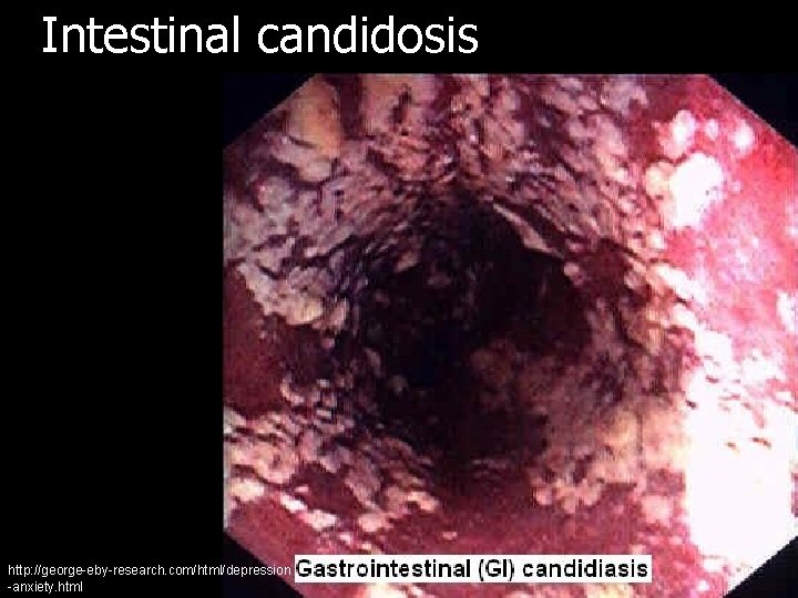 Intestinal candidosis http: //george-eby-research. com/html/depression -anxiety. html 