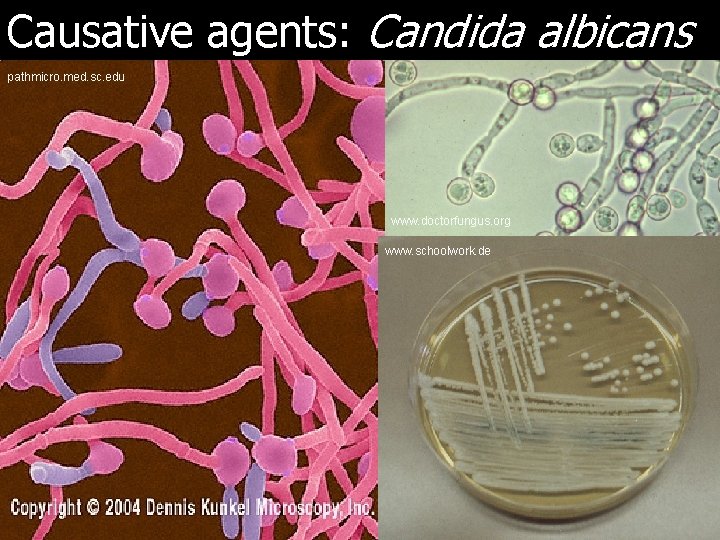 Causative agents: Candida albicans pathmicro. med. sc. edu www. doctorfungus. org www. schoolwork. de