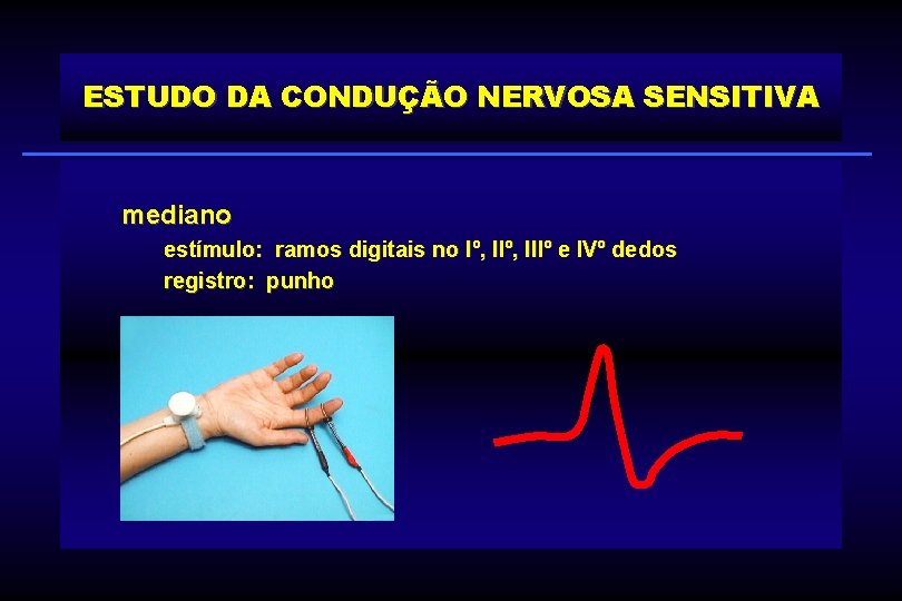 ESTUDO DA CONDUÇÃO NERVOSA SENSITIVA mediano estímulo: ramos digitais no Iº, IIIº e IVº