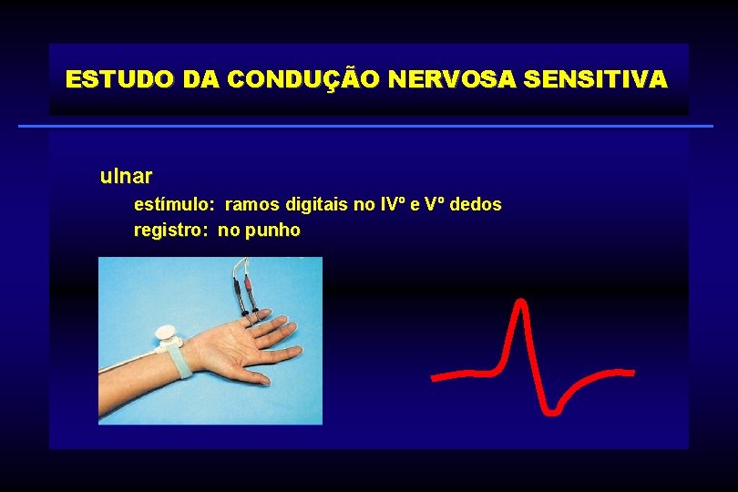 ESTUDO DA CONDUÇÃO NERVOSA SENSITIVA ulnar estímulo: ramos digitais no IVº e Vº dedos