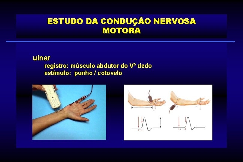 ESTUDO DA CONDUÇÃO NERVOSA MOTORA ulnar registro: músculo abdutor do Vº dedo estímulo: punho