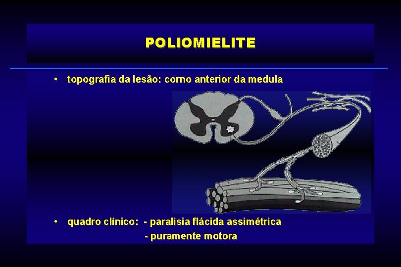 POLIOMIELITE • topografia da lesão: corno anterior da medula • quadro clínico: - paralisia