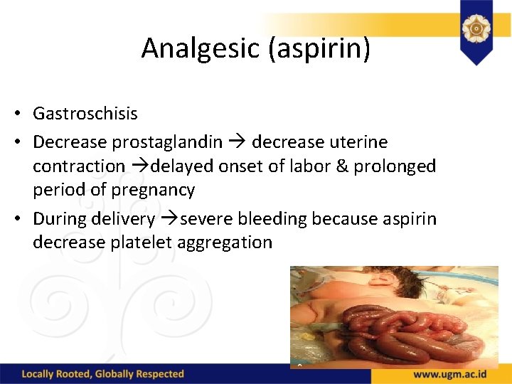 Analgesic (aspirin) • Gastroschisis • Decrease prostaglandin decrease uterine contraction delayed onset of labor
