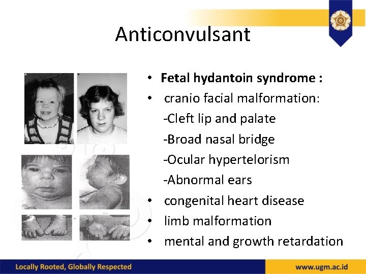 Anticonvulsant • Fetal hydantoin syndrome : • cranio facial malformation: -Cleft lip and palate