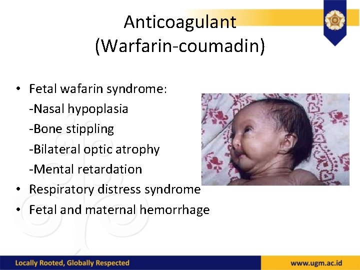 Anticoagulant (Warfarin-coumadin) • Fetal wafarin syndrome: -Nasal hypoplasia -Bone stippling -Bilateral optic atrophy -Mental