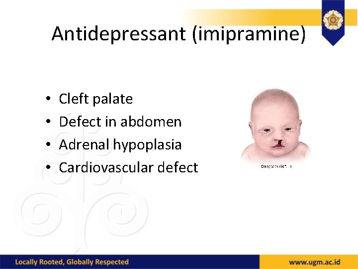 Antidepressant (imipramine) • • Cleft palate Defect in abdomen Adrenal hypoplasia Cardiovascular defect 