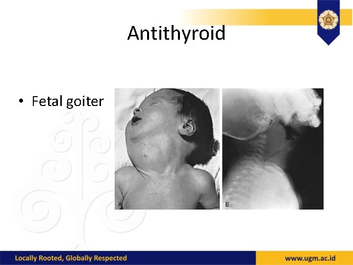 Antithyroid • Fetal goiter 