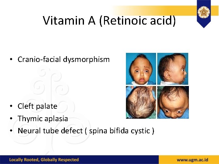 Vitamin A (Retinoic acid) • Cranio-facial dysmorphism • Cleft palate • Thymic aplasia •