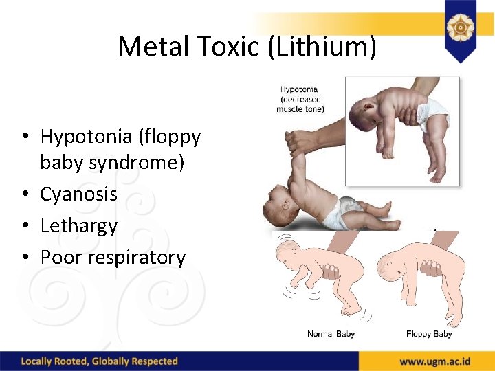 Metal Toxic (Lithium) • Hypotonia (floppy baby syndrome) • Cyanosis • Lethargy • Poor