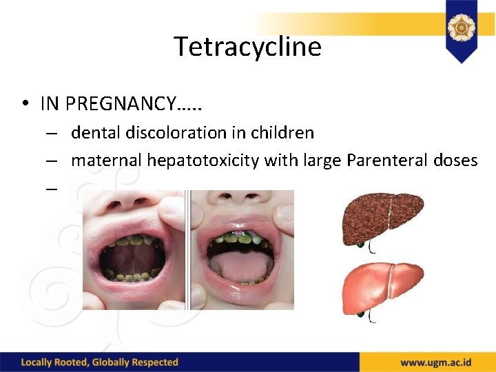Tetracycline • IN PREGNANCY…. . – dental discoloration in children – maternal hepatotoxicity with