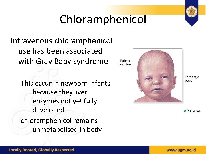 Chloramphenicol Intravenous chloramphenicol use has been associated with Gray Baby syndrome This occur in