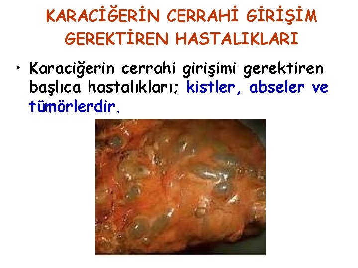 KARACİĞERİN CERRAHİ GİRİŞİM GEREKTİREN HASTALIKLARI • Karaciğerin cerrahi girişimi gerektiren başlıca hastalıkları; kistler, abseler