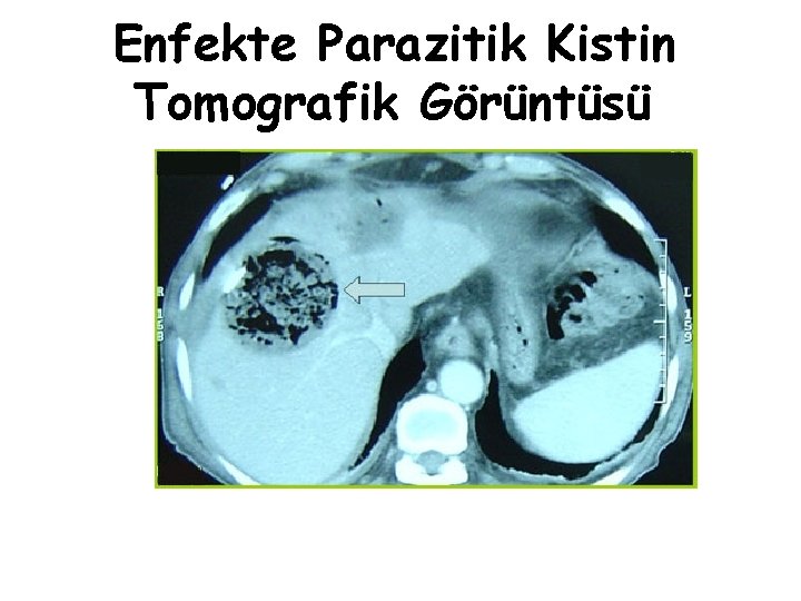 Enfekte Parazitik Kistin Tomografik Görüntüsü 