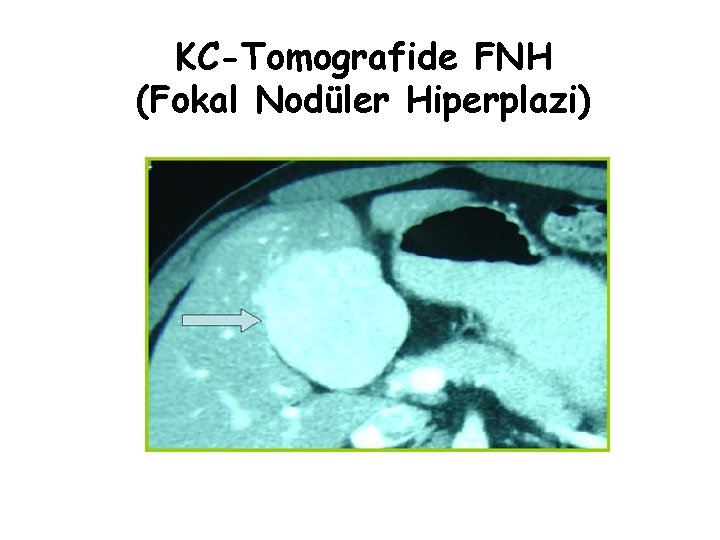 KC-Tomografide FNH (Fokal Nodüler Hiperplazi) 