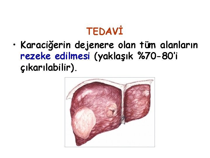 TEDAVİ • Karaciğerin dejenere olan tüm alanların rezeke edilmesi (yaklaşık %70 -80’i çıkarılabilir). 