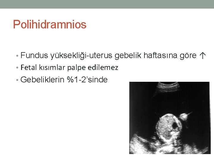 Polihidramnios • Fundus yüksekliği-uterus gebelik haftasına göre ↑ • Fetal kısımlar palpe edilemez •