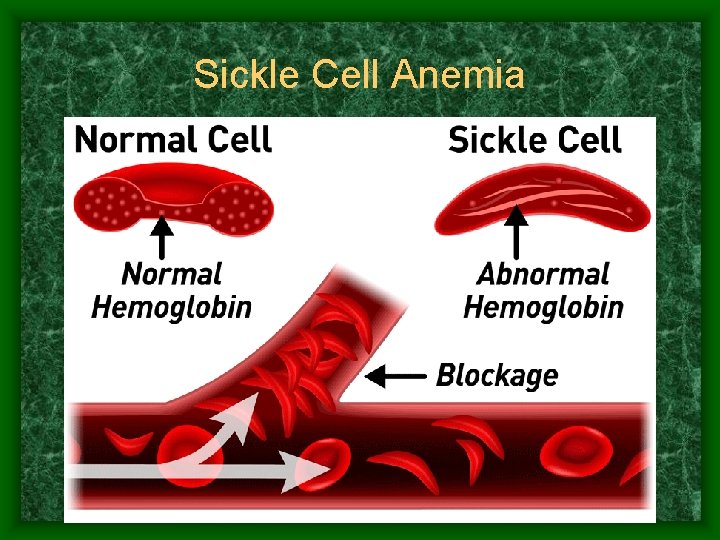 Sickle Cell Anemia 