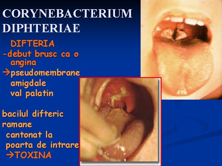 CORYNEBACTERIUM DIPHTERIAE DIFTERIA -debut brusc ca o angina pseudomembrane amigdale val palatin bacilul difteric