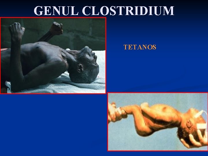 GENUL CLOSTRIDIUM TETANOS 