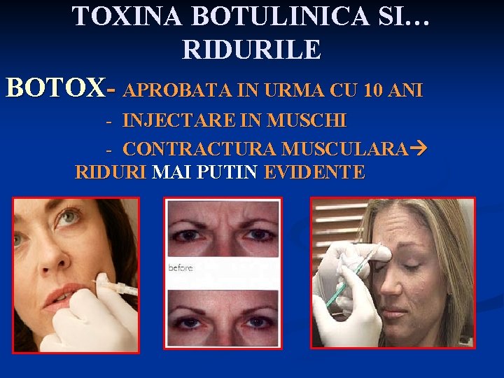 TOXINA BOTULINICA SI… RIDURILE BOTOX- APROBATA IN URMA CU 10 ANI - INJECTARE IN