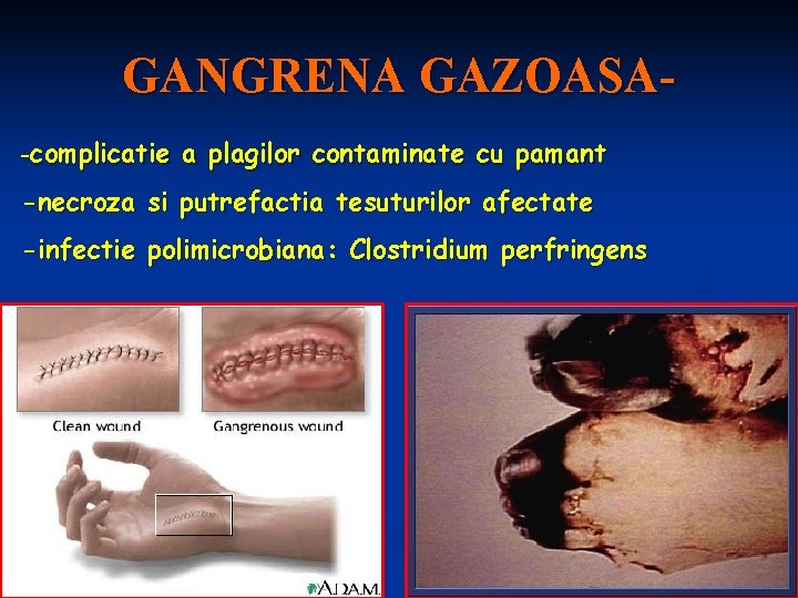 GANGRENA GAZOASA-complicatie a plagilor contaminate cu pamant -necroza si putrefactia tesuturilor afectate -infectie polimicrobiana: