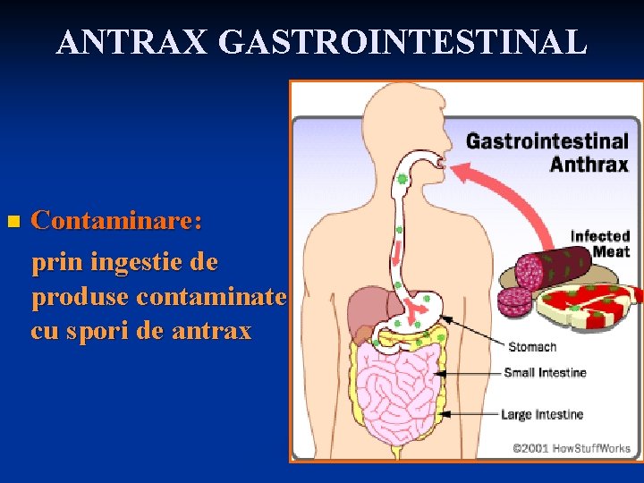 ANTRAX GASTROINTESTINAL n Contaminare: prin ingestie de produse contaminate cu spori de antrax 