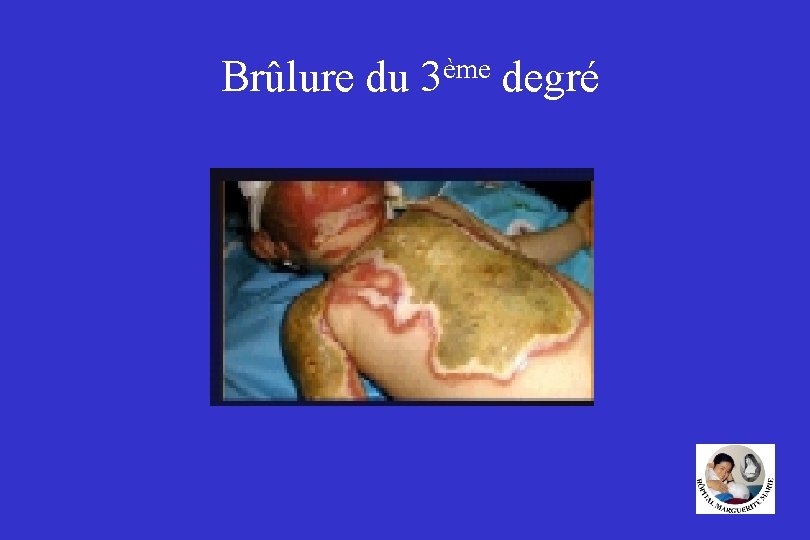 Brûlure du 3ème degré 