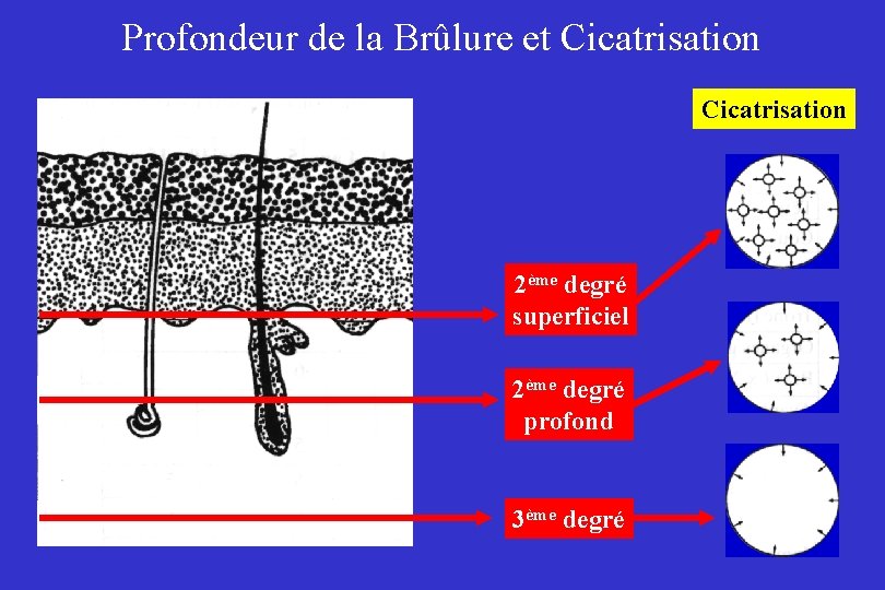 Profondeur de la Brûlure et Cicatrisation 2ème degré superficiel 2ème degré profond 3ème degré