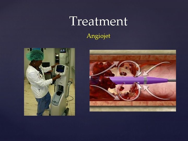 Treatment Angiojet 