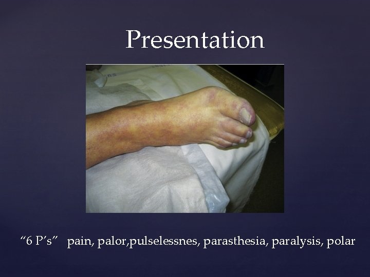 Presentation “ 6 P’s” pain, palor, pulselessnes, parasthesia, paralysis, polar 