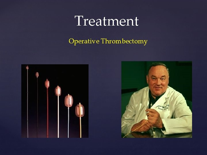 Treatment Operative Thrombectomy 