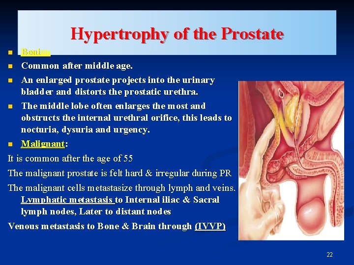 Hypertrophy of the Prostate Benign n Common after middle age. n An enlarged prostate
