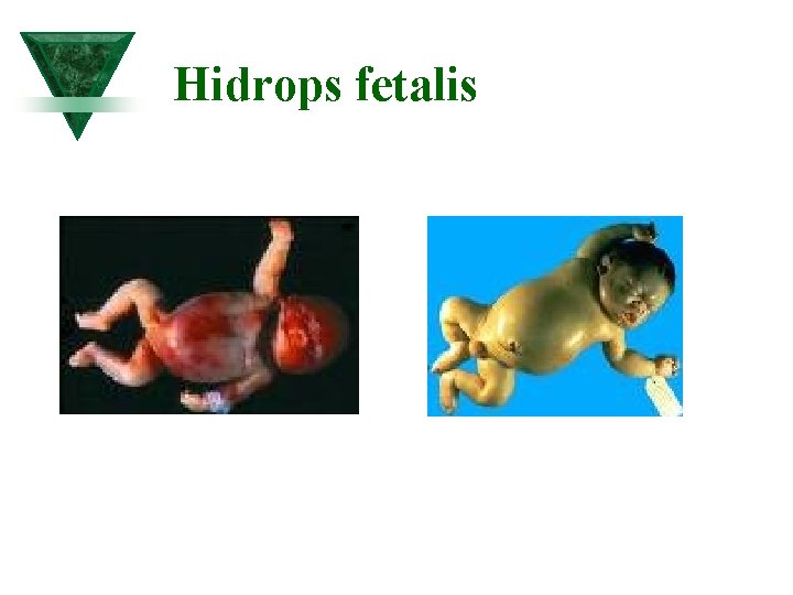 Hidrops fetalis 