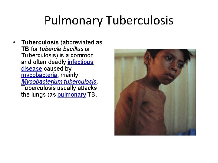 Pulmonary Tuberculosis • Tuberculosis (abbreviated as TB for tubercle bacillus or Tuberculosis) is a