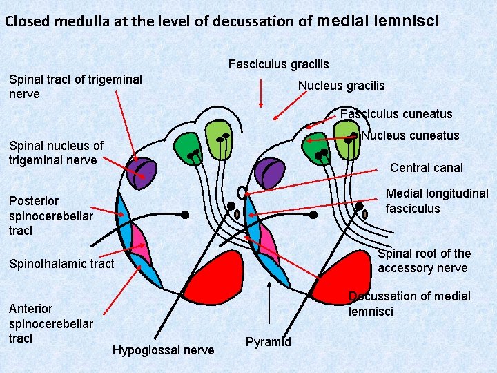 Closed medulla at the level of decussation of medial lemnisci Fasciculus gracilis Spinal tract