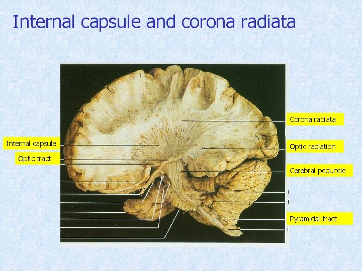 Internal capsule and corona radiata Corona radiata Internal capsule Optic radiation Optic tract Cerebral