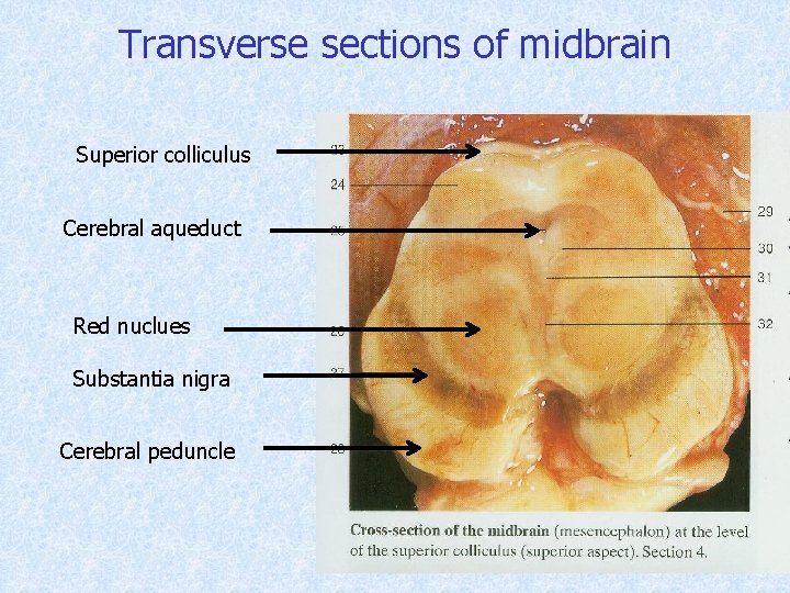 Transverse sections of midbrain Superior colliculus Cerebral aqueduct Red nuclues Substantia nigra Cerebral peduncle