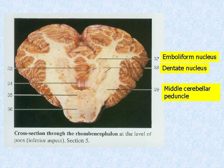 Emboliform nucleus Dentate nucleus Middle cerebellar peduncle 