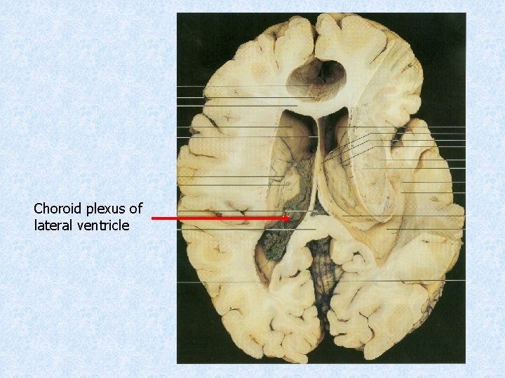 Choroid plexus of lateral ventricle 