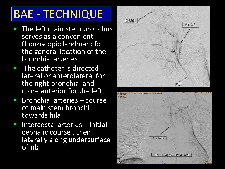 BAE - TECHNIQUE § The left main stem bronchus serves as a convenient fluoroscopic