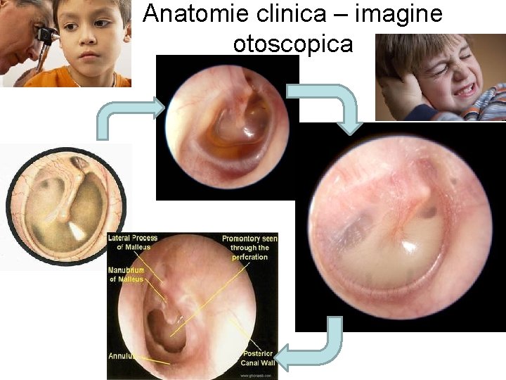 Anatomie clinica – imagine otoscopica 