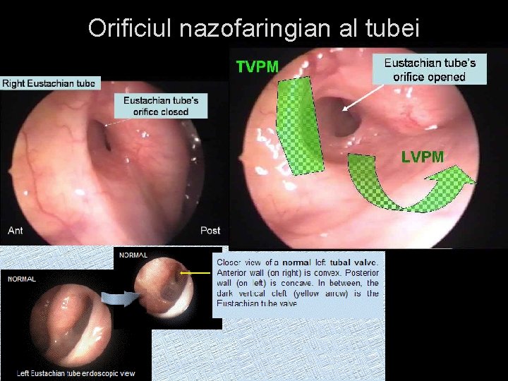 Orificiul nazofaringian al tubei 