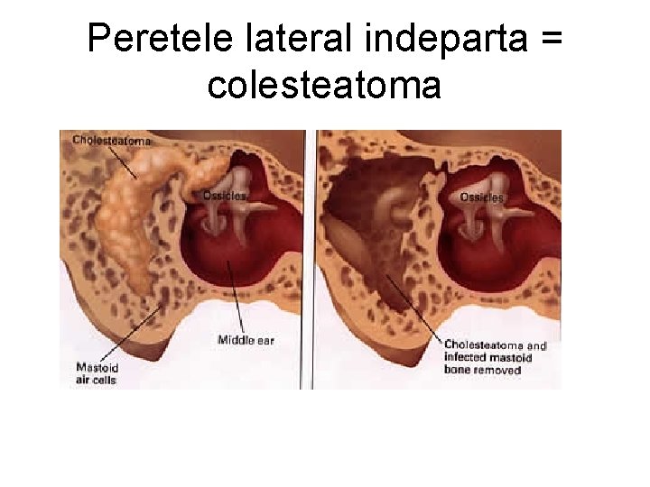 Peretele lateral indeparta = colesteatoma 