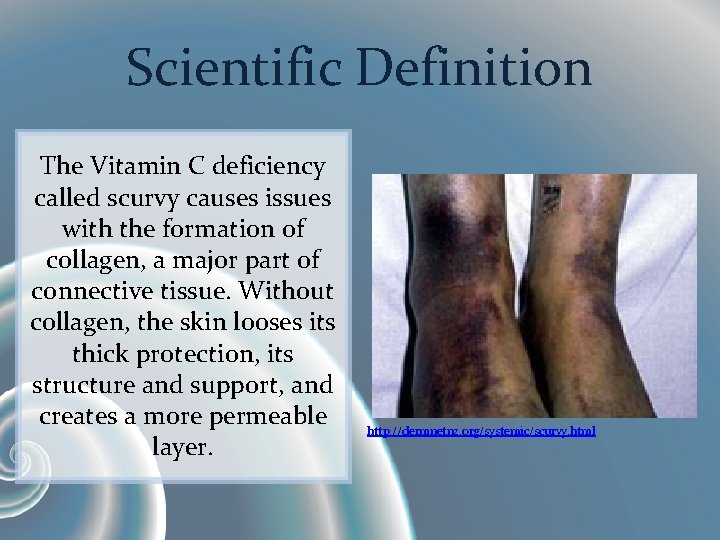 Scientific Definition The Vitamin C deficiency called scurvy causes issues with the formation of